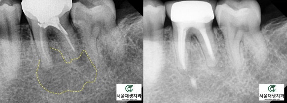 재신경치료의 치료 기간, 내원 횟수, 간격 (신촌치과, 서울재생치과, 서울대 보존과 전문의) 관련 이미지 10