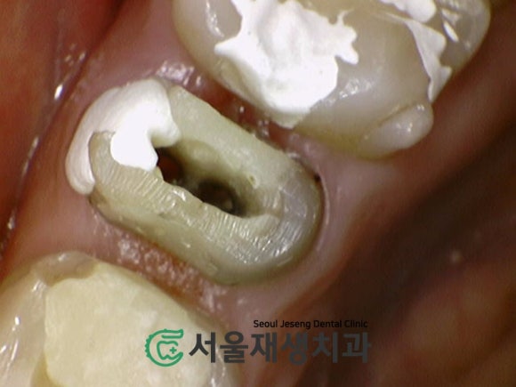 [재신경치료] 다른 치과에서 빼라고 했는데...혹시 살릴 수는 없을까요? (현미경 신경치료, 서울재생치과) 관련 이미지 6