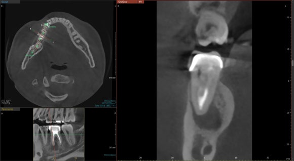 [재신경치료] 20대 남성, 9년 전에 신경치료한 치아에서 고름이 나와요. 관련 이미지 5