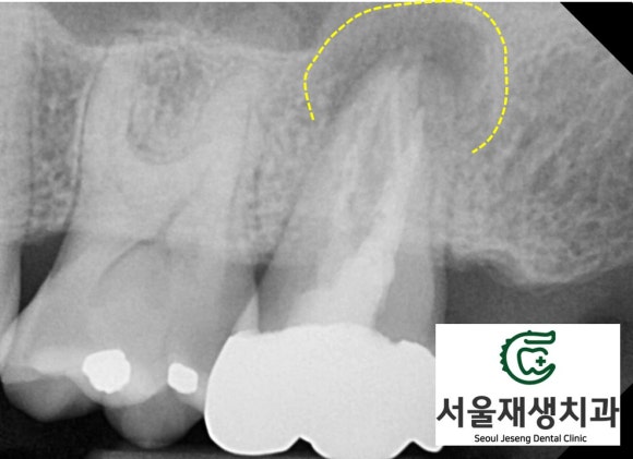 [재신경치료] 40대 남성, 윗 어금니 신경치료 후 상악동까지 염증이 전파된 사례 (서울재생치과 미세현미경치료) 관련 이미지 4