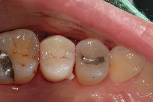 A Tooth Filled with Amalgam Long Ago Has Cracked. image 6