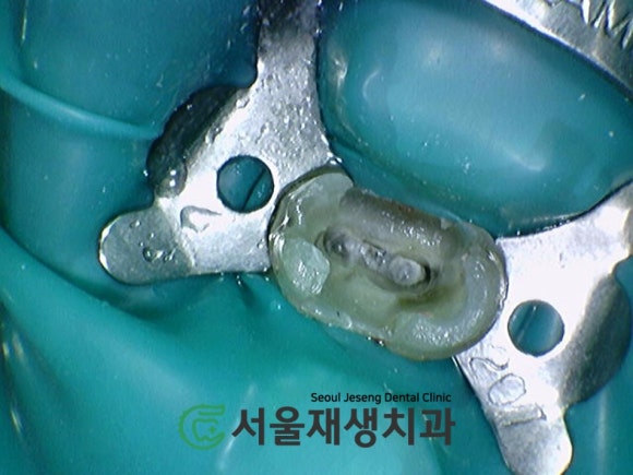 [재신경치료] 다른 치과에서 빼라고 했는데...혹시 살릴 수는 없을까요? (현미경 신경치료, 서울재생치과) 관련 이미지 7