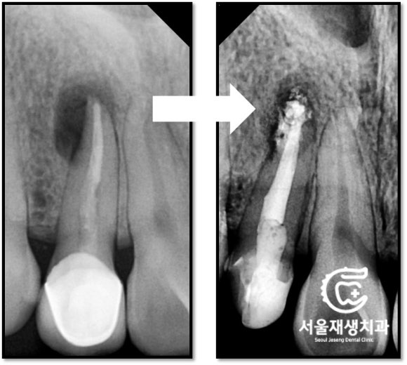 [재신경치료] 소중한 내 앞니...재신경치료로 다시 한 번 살려 쓸 수 있습니다. (서울재생치과, 현미경신경치료) 관련 이미지 13