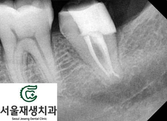 치아 뿌리에 생긴 충치...살릴 수 있는 방법 없을까요? 현미경을 이용하여 보다 꼼꼼하게! 관련 이미지 6
