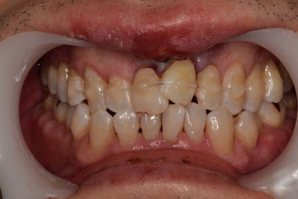 [치아외상] 넘어졌는데 이가 쏘옥 빠졌어요....! (안면부 외상, 치아 탈구, 치아 재식,서울재생치과) 관련 이미지 5