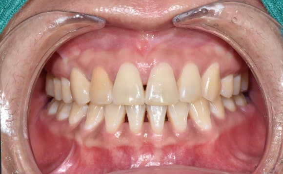 치아가 변색되면 무조건 크라운을 해야 하나요? (치아 미백, 실활치 미백, 신경치료 후 미백, 신촌치과추천,서울재생치과) 관련 이미지 11