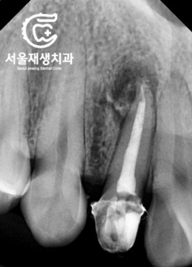 [재신경치료] 소중한 내 앞니...재신경치료로 다시 한 번 살려 쓸 수 있습니다. (서울재생치과, 현미경신경치료) 관련 이미지 10