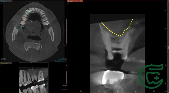 [재신경치료] 다른 치과에서 재신경치료했는데 여전히 불편해요. 40대 남성 환자분의 재재신경치료 이야기. 관련 이미지 5
