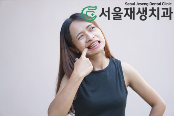 잇몸 패임, 무슨 재료로 때우나요? 레진과 글라스아이오노머(GI)로 치경부마모증 치료하기 (서울재생치과,신촌치과) 관련 이미지 4
