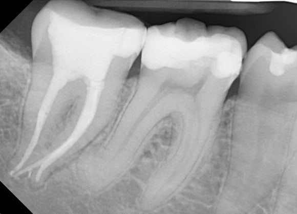 [재신경치료] 아래 어금니를 영국에서 신경치료 했는데, 아파져서 다시 치료 받고 싶어요. 관련 이미지 5