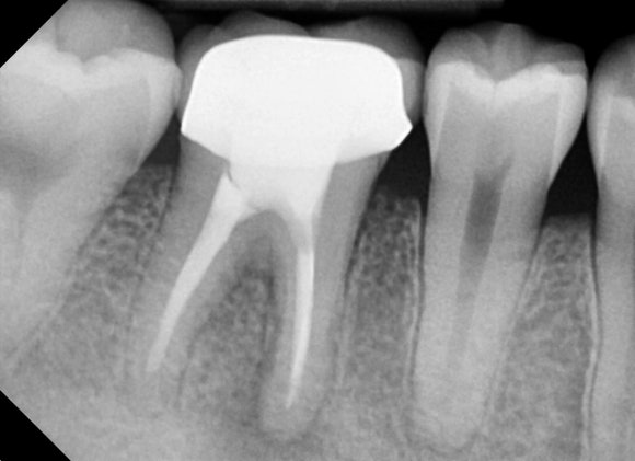 [재신경치료] 20대 남성, 9년 전에 신경치료한 치아에서 고름이 나와요. 관련 이미지 4