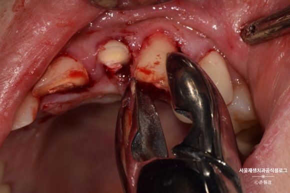 [치아외상] 부러진 앞니, 발치가 답인가요? (사고로 부러진 치아, 외과적정출술로 살리기) 관련 이미지 5