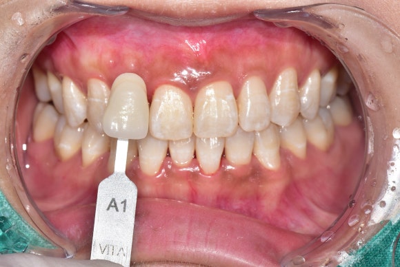 치과에서 미백치료를 받은 후에 치아에 하얀 반점이 생기고 얼룩덜룩해졌어요. 관련 이미지 5
