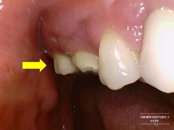 임플란트가 아플 때, 임플란트 잇몸이 부었을 때 어떻게 하나요? (임플란트 재수술, 서울재생치과, 신촌치과) 관련 이미지 6