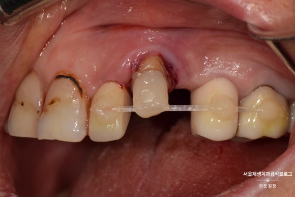 충치나 파절로 짧아진 치아도 다시 보자! (의도적 재식술/치아정출술 후 브릿지치료) 관련 이미지 7