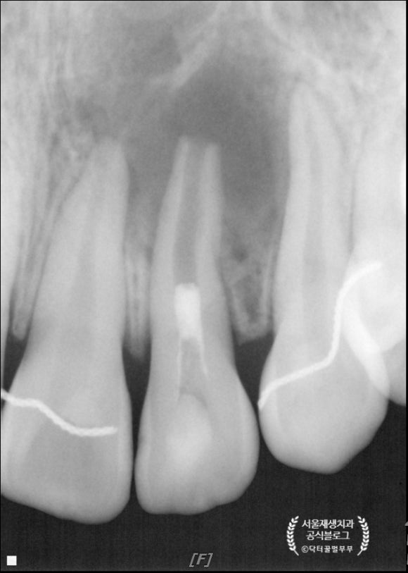 [재생근관치료] 이가 난지 얼마 안 됐는데 신경이 죽었대요...(소아 치아 외상, 치수 괴사, 미성숙 영구치, 신경재생술, REP, 치료기간, MTA 신경치료, 내원횟수) 관련 이미지 8