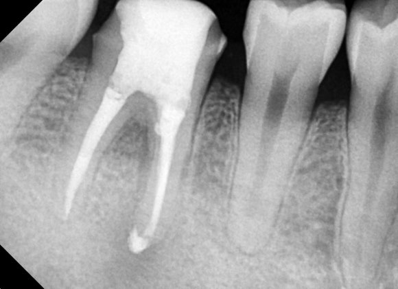 [재신경치료] 20대 남성, 9년 전에 신경치료한 치아에서 고름이 나와요. 관련 이미지 9