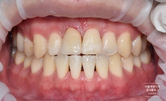 넘어져서 이가 여러군데 깨졌어요ㅠ (치아외상토탈케어, 서울재생치과, 치아 부러짐, 치아 파절) 관련 이미지 4