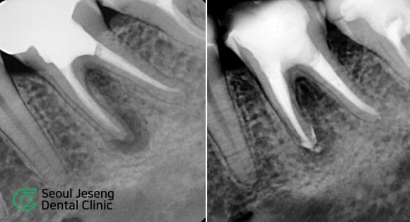 [치료사례] 재신경치료 (5) 관련 이미지 1