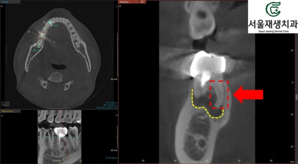 [재신경치료] 신경치료 받은 치아가 붓고 아파요! 현미경과 CT의 도움으로 다시 한 번 꼼꼼하게~ 관련 이미지 9
