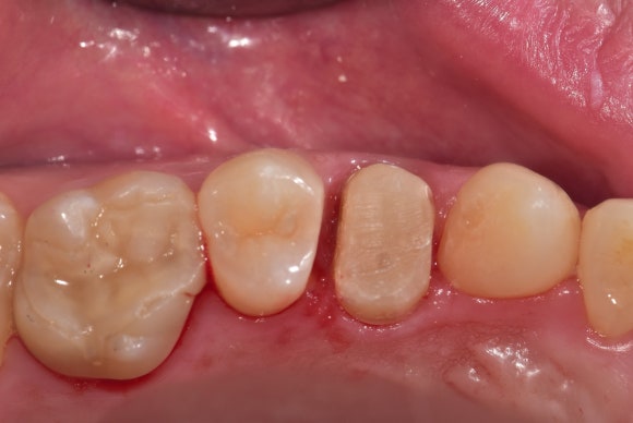 [신경치료] 충치가 커서 뿌리만 남았대요. 비발치 신경치료로 자연치아 살리기! 관련 이미지 9