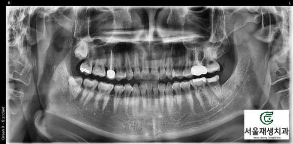 [재신경치료] 예전에 신경치료 받은 치아가 갑자기 너무 아파요! (서울재생치과, 현미경신경치료) 관련 이미지 3