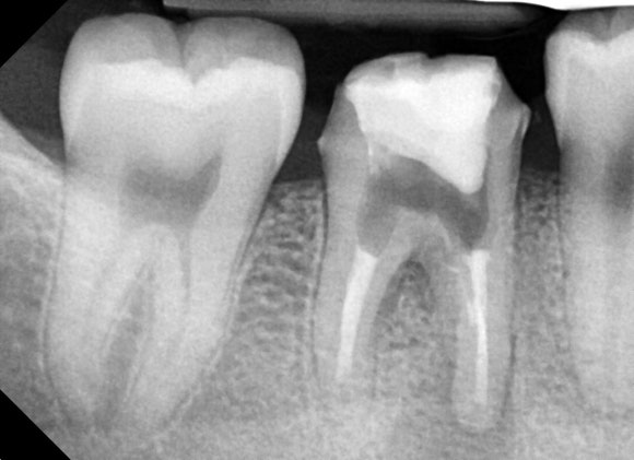 [재신경치료] 20대 남성, 9년 전에 신경치료한 치아에서 고름이 나와요. 관련 이미지 8