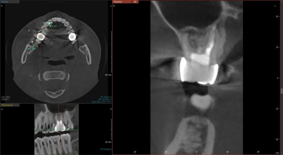 [재신경치료] 10년전에 한 신경치료가 뭔가 불편해요... 관련 이미지 8