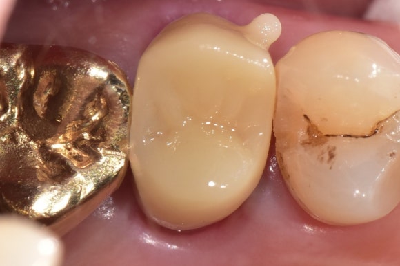 부러진 치아를 살려서 쓰는 법 (잇몸성형과 포스트식립) 관련 이미지 8