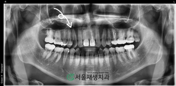 [치아정출술] 충치가 뿌리까지 진행되서 발치해야 한대요...뿌리 깊은 충치도 살려내기 (서울재생치과) 관련 이미지 3