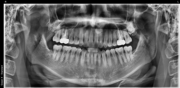[재신경치료] 10년전에 한 신경치료가 뭔가 불편해요... 관련 이미지 3