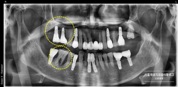임플란트가 아플 때, 임플란트 잇몸이 부었을 때 어떻게 하나요? (임플란트 재수술, 서울재생치과, 신촌치과) 관련 이미지 5