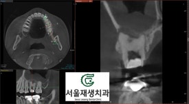 [재신경치료] 재신경치료까지 했는데 계속 아파요..미세 현미경을 이용한 세번째 신경치료! (서울재생치과) 관련 이미지 9