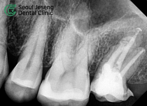 [재신경치료] 타치과에서 재신경치료 하는 중인데 발치를 하자고 했어요... (서울재생치과 현미경 신경치료) 관련 이미지 7