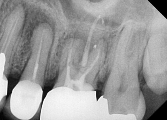 [재신경치료] 신경치료 받은 치아가 아프고 흔들려요 (ft. Zeiss미세현미경) 관련 이미지 3
