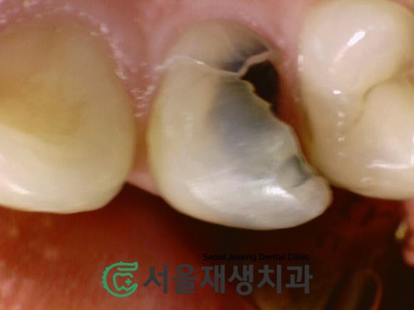 [치아정출술] 충치가 뿌리까지 진행되서 발치해야 한대요...뿌리 깊은 충치도 살려내기 (서울재생치과) 관련 이미지 7