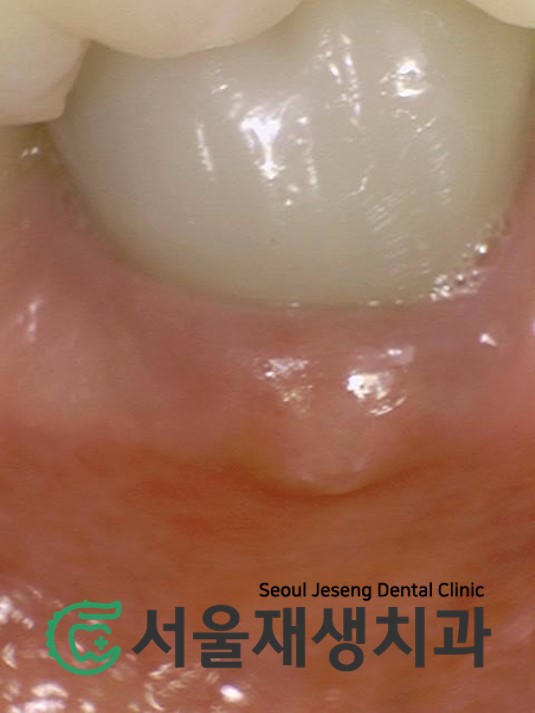 [재신경치료] 신경치료 받은 치아가 붓고 아파요! 현미경과 CT의 도움으로 다시 한 번 꼼꼼하게~ 관련 이미지 4