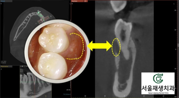 [치외치신경치료] 뿌리 끝 염증이 커서 발치해야된대요! 치아 머리에 볼~록! 알고보면 무서운 작은 혹 (서울재생치과) 관련 이미지 14