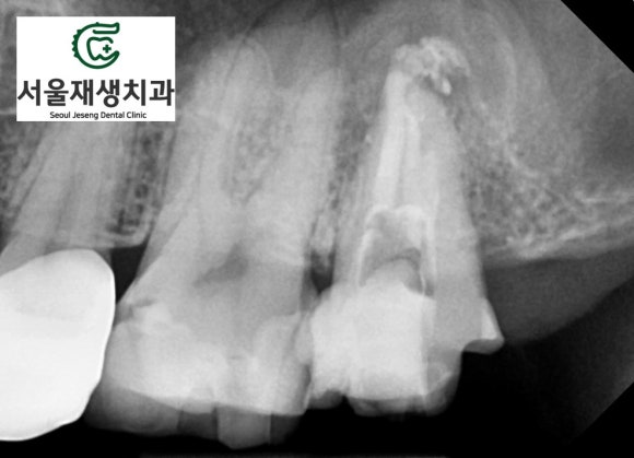 [재신경치료] 예전에 신경치료 한 치아가 갑자기 붓고 아파요! (현미경 신경치료, 서울재생치과) 관련 이미지 8