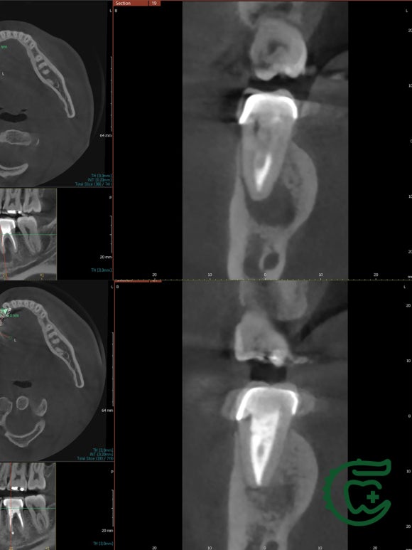 [재신경치료] 20대 남성, 9년 전에 신경치료한 치아에서 고름이 나와요. 관련 이미지 12
