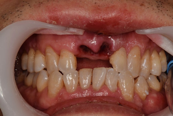 [치아외상] 넘어졌는데 이가 쏘옥 빠졌어요....! (안면부 외상, 치아 탈구, 치아 재식,서울재생치과) 관련 이미지 2