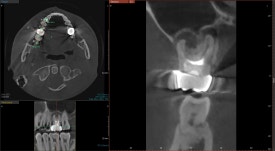 [재신경치료] 10년전에 한 신경치료가 뭔가 불편해요... 관련 이미지 9