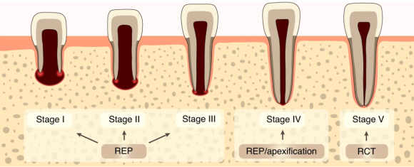 [재생근관치료] 이가 난지 얼마 안 됐는데 신경이 죽었대요...(소아 치아 외상, 치수 괴사, 미성숙 영구치, 신경재생술, REP, 치료기간, MTA 신경치료, 내원횟수) 관련 이미지 3