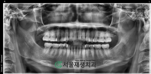 [치아파절] 밥 먹다가 이가 반으로 쪼개졌어요....이런 치아도 살릴 수 있나요? (깨진 치아 치료하기, 신촌 서울재생치과) 관련 이미지 3