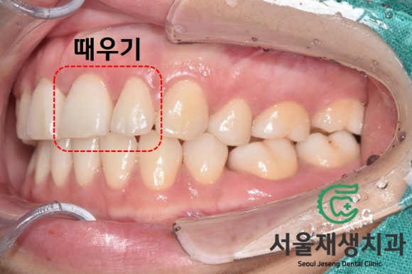 [깨진앞니치료] 살짝 다듬고, 살짝 때우고! (서울재생치과 신촌) 관련 이미지 7