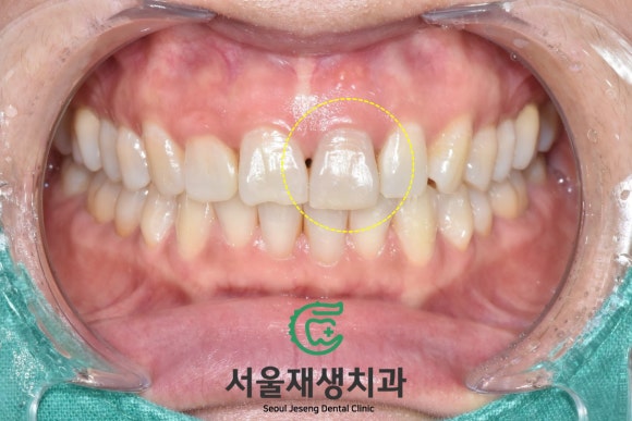[치아미백] 예전에 다친 치아가 최근에 변색됐어요. 어떻게 해결하나요? (서울재생치과) 관련 이미지 3
