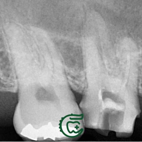 [재신경치료] 다른 치과에서 재신경치료했는데 여전히 불편해요. 40대 남성 환자분의 재재신경치료 이야기. 관련 이미지 4