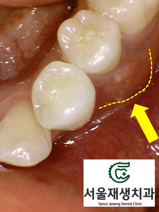 [치외치신경치료] 뿌리 끝 염증이 커서 발치해야된대요! 치아 머리에 볼~록! 알고보면 무서운 작은 혹 (서울재생치과) 관련 이미지 5