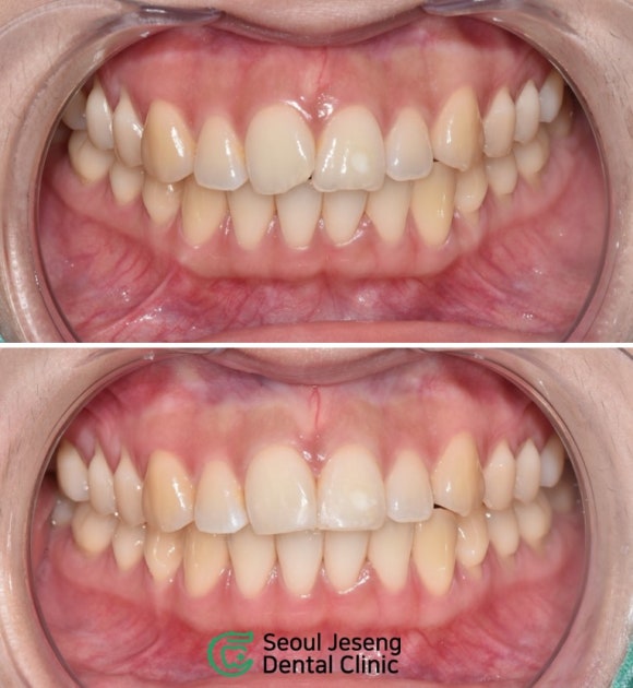 [치료사례] 전치부레진수복 (조금 깨진 앞니를 어떻게 치료하나요? 서울재생치과) 관련 이미지 1