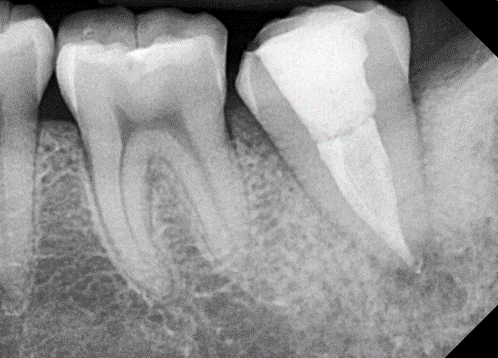 [신경치료] 아래 어금니를 신경치료 할 때 치료할 때 알아야 할 것 (C형근관,고난이도치료) 관련 이미지 8